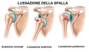 l signor B.F. lussazione-
