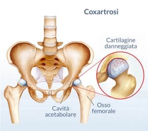 la signora A.G. coxartrosi