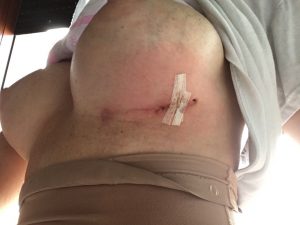 La signora D.I. PROTESI AL SENO