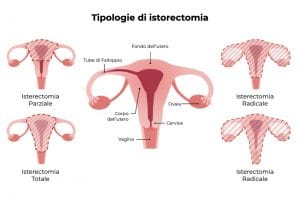 isterectomia