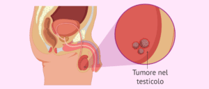 tumore testicolo