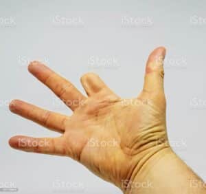 amputazione dito